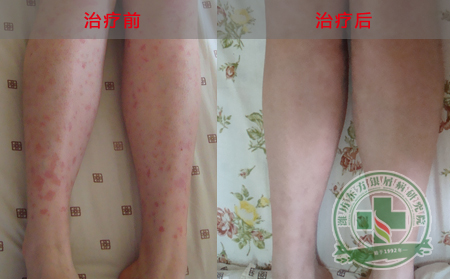 關(guān)節(jié)型銀屑病