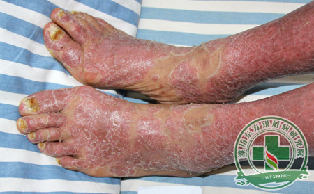 春季的關(guān)節(jié)病型銀屑病怎樣預(yù)防