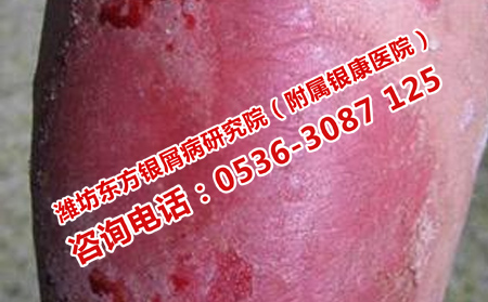 牛皮癬治療的方法是什么呢