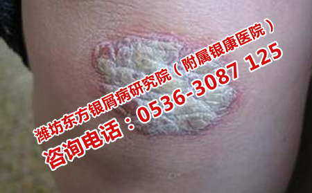 中醫(yī)治療牛皮癬的特點是什么
