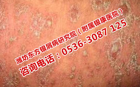 如何面對(duì)牛皮癬的復(fù)發(fā)