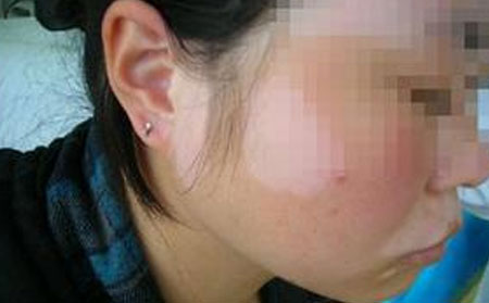 頭部白癜風,白癜風飲食,白癜風常識,白癜風知識