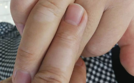 白癜風預防護理,治療白癜風,濰坊銀康白癜風醫院