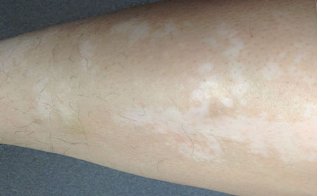 白癜風心理,白癜風常識,濰坊銀康白癜風醫院