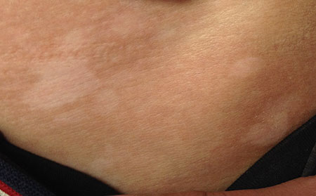 早期白癜風,白癜風的癥狀,早期白癜風的癥狀