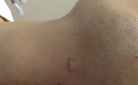 治療白癜風,治療白癜風方法,治療白癜風醫院