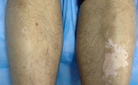 治療白癜風(fēng),治療白癜風(fēng)多少錢,濰坊市治療白癜風(fēng)多少錢