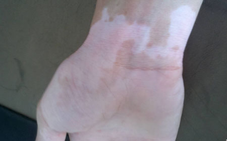 女性白癜風(fēng),孕婦白癜風(fēng),白癜風(fēng)危害有哪些