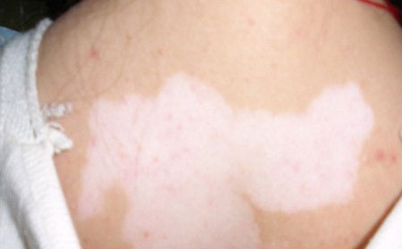 預防白癜風,濰坊白癜風醫院,白癜風怎么預防