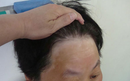 預防白癜風,白癜風預防要點,濰坊白癜風醫院