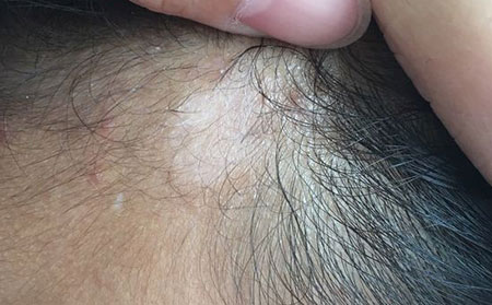 白癜風發病原因,白癜風病因,誘發白癜風的原因