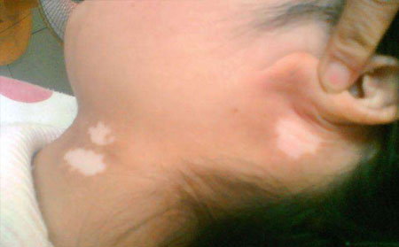 白癜風發病原因,白癜風病因,誘發白癜風的原因