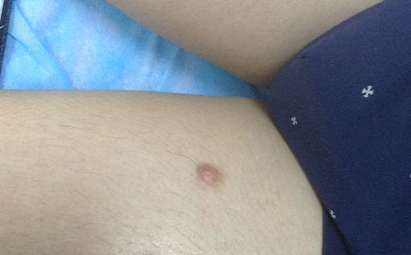 預防白癜風,預防白癜風的方法