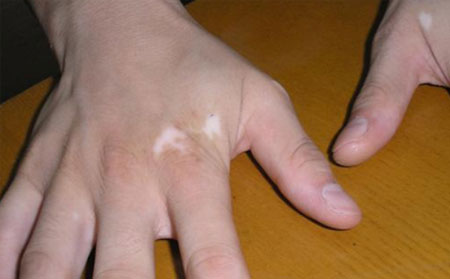 白癜風發病原因,白癜風病因,濰坊白癜風醫院