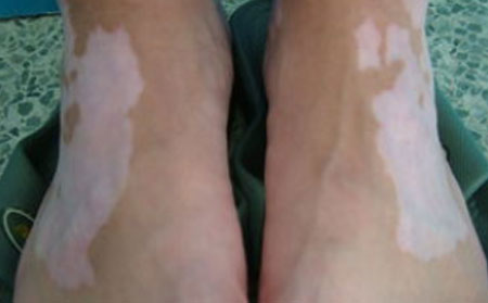 治療白癜風,面部白癜風治療,白癜風治療方法