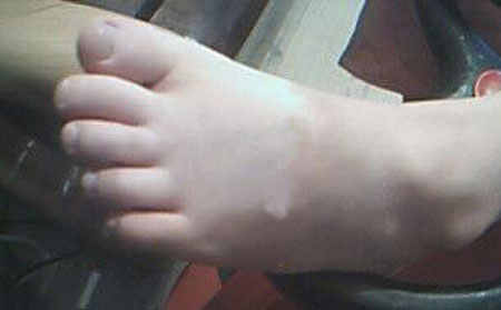 白癜風癥狀,白癜風癥狀圖片