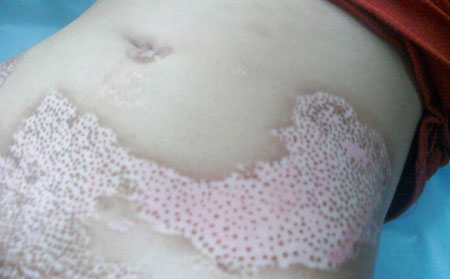 治療白癜風,白癜風飲食,白癜風吃什么好