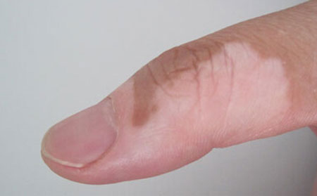 頭部白癜風,白癜風辨別