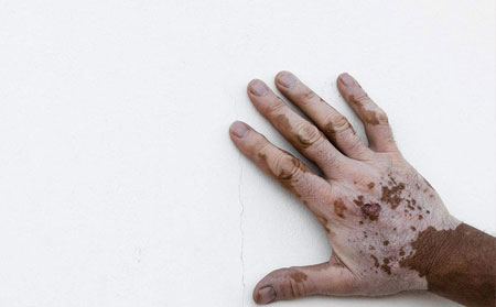 白癜風發(fā)病原因,引起白癜風的病因