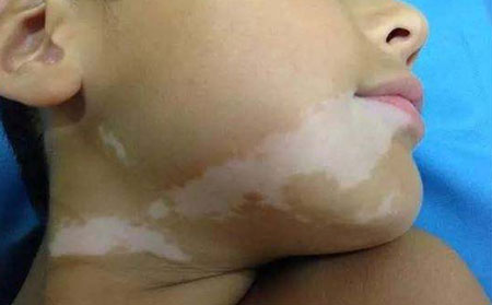 白癜風護理,如何護理白癜風