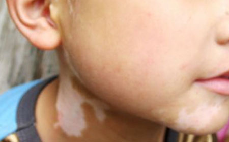 日常生活中大家如何預防白癜風