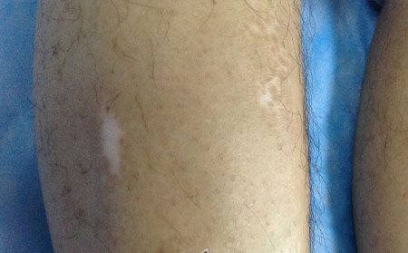 青少年身上出現白癜風了怎么辦