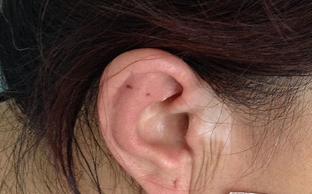 白癜風(fēng)如何治療,青少年治療白癜風(fēng),治療白癜風(fēng)醫(yī)院