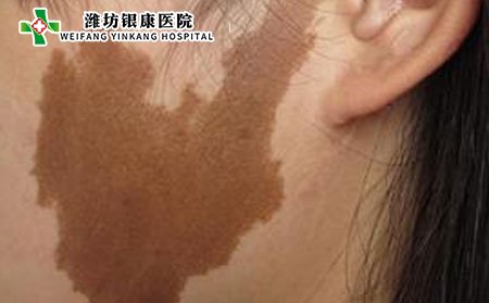 黃褐斑是怎么形成的?電腦族預(yù)防黃褐斑圖片